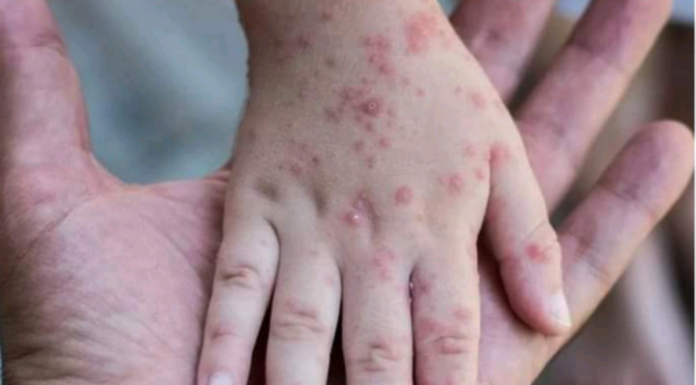 OMS: Les épidémies de mpox « peuvent être maîtrisées »