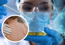 Premier cas de Mpox détecté en Jordanie