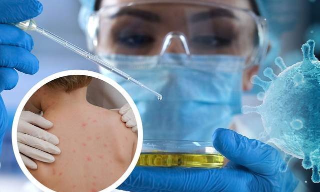 Maroc: Un touriste en vacances hospitalisé avec une suspicion de Mpox