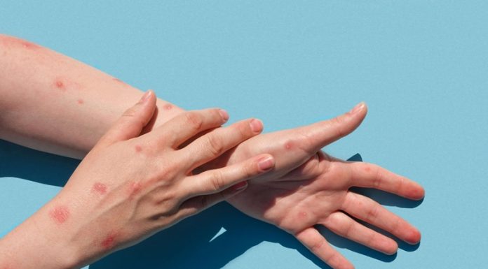 La Tunisie s’est-elle préparée à une éventuelle propagation de la variole du singe ?
