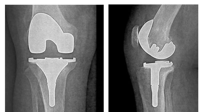 Santé : Réussite d’une arthroplastie totale du genou à l’hôpital régional de Jendouba